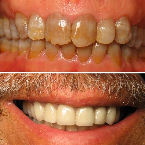 Smile Transformation: Before and After Dental Crowns