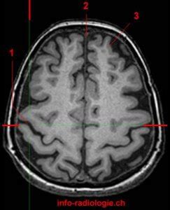 Central Sulcus - Definition, Location (MRI) and Function - (updated in ...