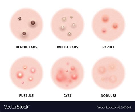 Skin acne types diagram disease pimples Royalty Free Vector