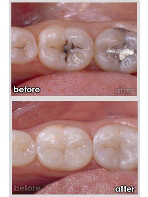 Dentist in Idaho Falls ID: Cavities 101 | Idaho Falls Smiles