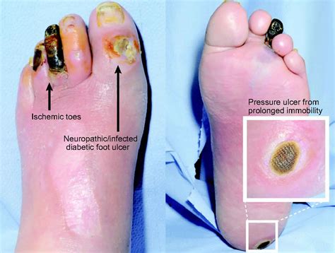 Chronic wound, causes, symptoms, diagnosis & treatment