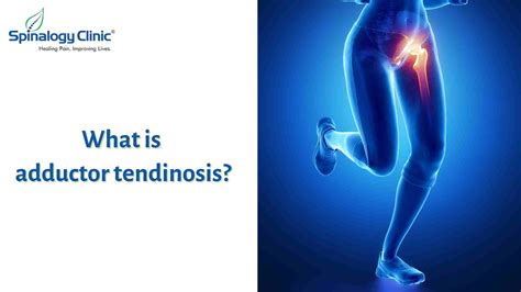 Understanding Adductor Tendinosis: Causes, Symptoms, and Treatment ...