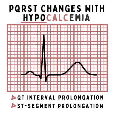 Hypocalcemia Ecg