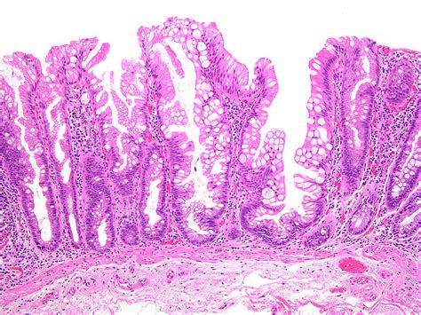 Pólipo séssil serrilhado do cólon e reto | MyPathologyReport.ca