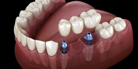 Best Dental Implants Near Me | Memorial Dentists