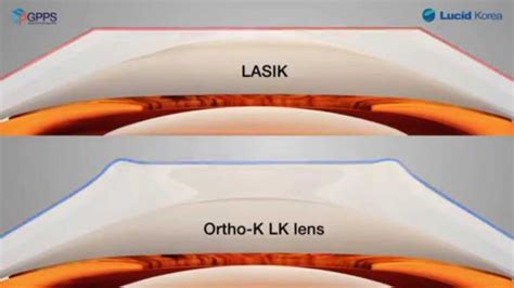 Things You Need to Know About Ortho K Lenses | SeeReadShare