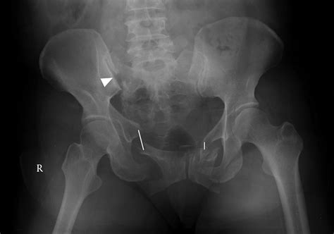 Pelvic Fracture X Ray