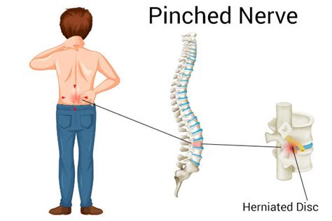 What Causes a Pinched Nerve in the Hip & How to Treat It?