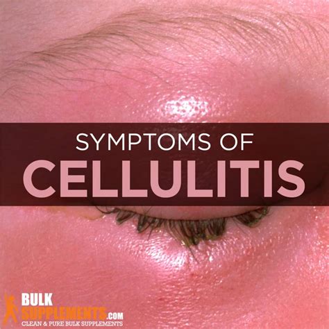 Cellulitis: Symptoms, Causes & Treatment