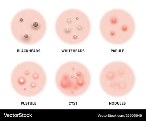 Skin acne types diagram skin disease pimples Vector Image