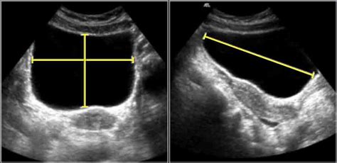 The Radiology Assistant : Normal Values - Ultrasound