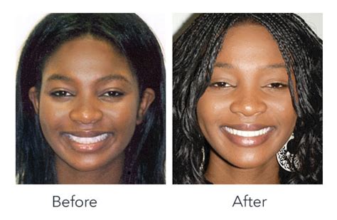 Invisalign® Before & After – PCO