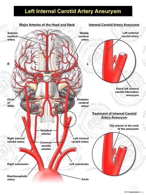 Internal Carotid Artery Model