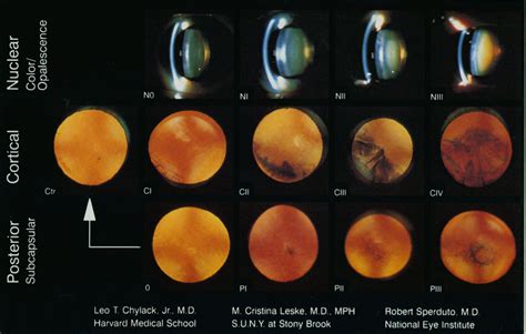 Grading cataracts - The Cataract Course