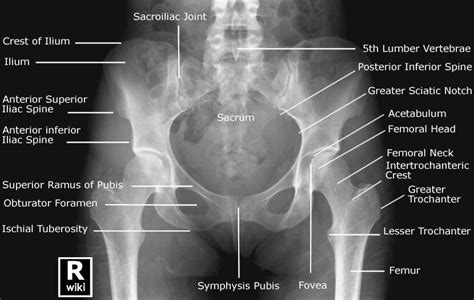 Adult Pelvis - AP View female Pelvis radiographic anatomy | Radiology, Medical anatomy, Anatomy