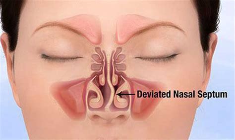 Is It Possible To Fix Deviated Septum Without Surgery | earth-base