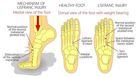 Dorsal Foot Pain [Causes, Symptoms & Best Treatment]