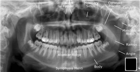 Dentistry lectures for MFDS/MJDF/NBDE/ORE: Radiographic Anatomy of ...