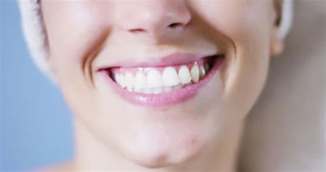 Are There Different Types of Dental Restoration Services? - Smiles in ...