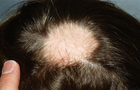 Alopecia areata causes, symptoms and best treatment for alopecia areata