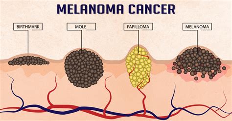 Melanoma cancer (skin cancer)- healthreactive.com :: Health Reactive Body Revival