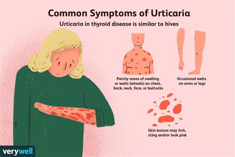 What Are The Symptoms Of Chronic Hives | Allergy Trigger