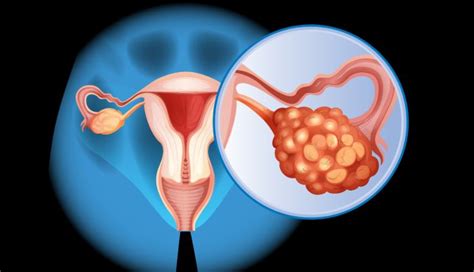 Ovarian cancer stages: How they are determined | MD Anderson Cancer Center