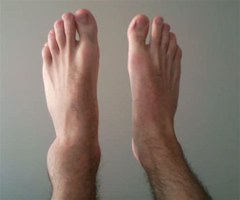 Ankle Instability - Ankle Sprains - Ankle Pain | Preferred Foot & Ankle