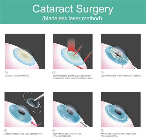 Cost Of Lenses After Cataract Surgery at William Muldowney blog