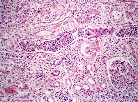 Chronic Pyelonephritis Histology