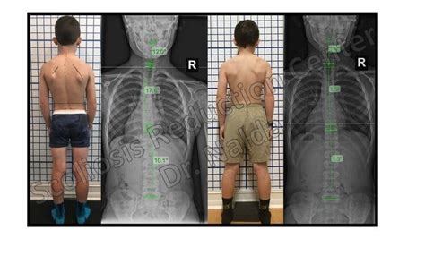 Scoliosis Before And After