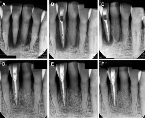 Periapical radiography of Case B: (A) Initial radiography, (B ...