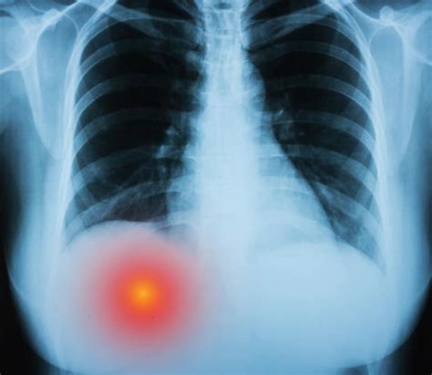 What Causes Pain Under Right Rib Cage? - Health Synonyms