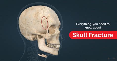 Skull Fracture: Types, Causes, and Symptoms - Skedoc