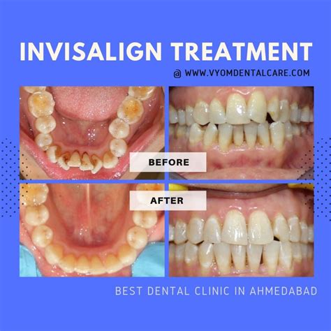 Invisalign treatment in Ahmedabad | Affordable Invisible Braces Cost in India