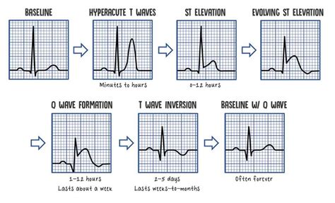 STEMI & NSTEMI: A Nurse's Comprehensive Guide | Health And Willness