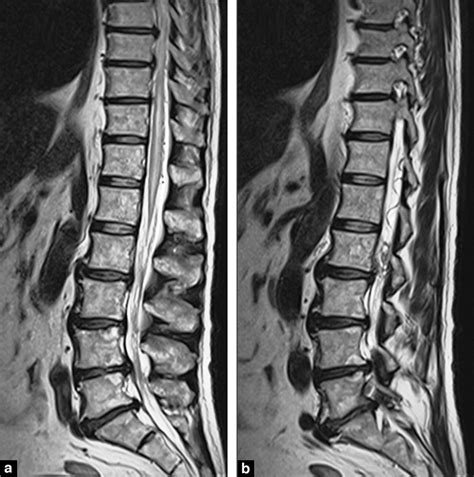 T2-weighted spinal cord MRI centered on the lumbosacral region: a:... | Download Scientific Diagram