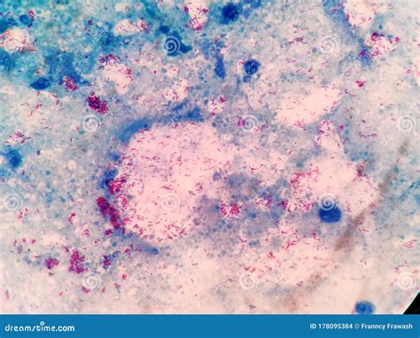 Acid-fast Bacilli. Ziehl Neelsen Stain Stock Photo - Image of analysis ...