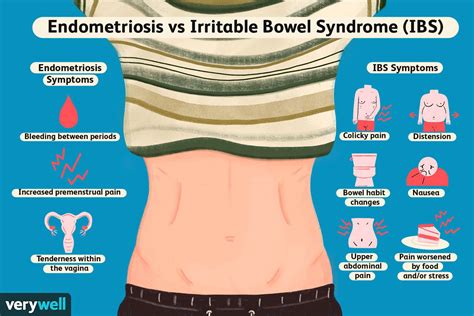 The Differences Between Endometriosis and IBS