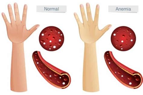 Anemia Symptoms: 13 Warning Signs Of Anemia, Common Symptoms Of Anemia - TheLifeToday