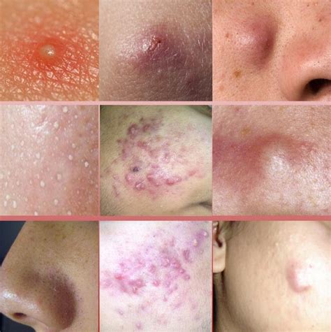 Acne Nodules On Face