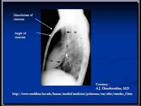 Labeled Lateral Chest X Ray