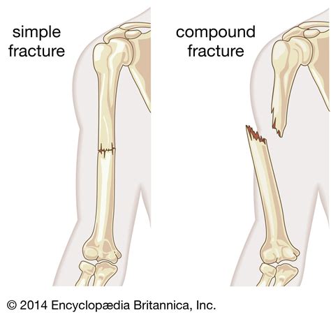 Complete Fracture Diagram