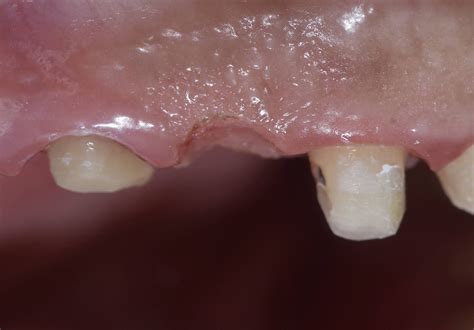 Dental Esthetics: Ovate pontic for the correct emergence profile.. A clinical case