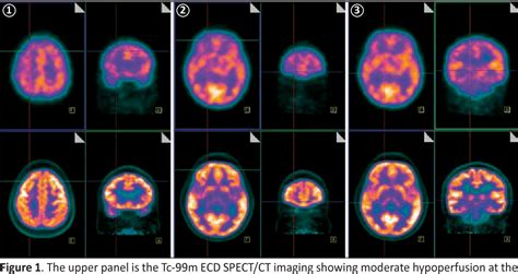 Figure 1 from Impact of Single-Photon Emission Computed Tomography ...