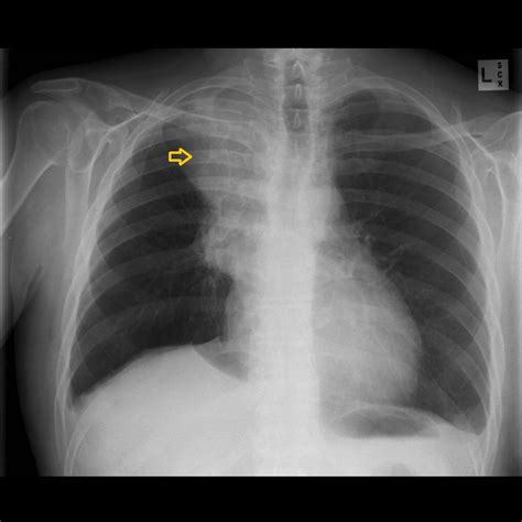 Small cell carcinoma of the lung x ray - wikidoc