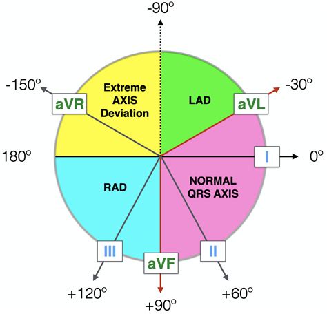 Right Axis Deviation (RAD) • LITFL • ECG Library Diagnosis