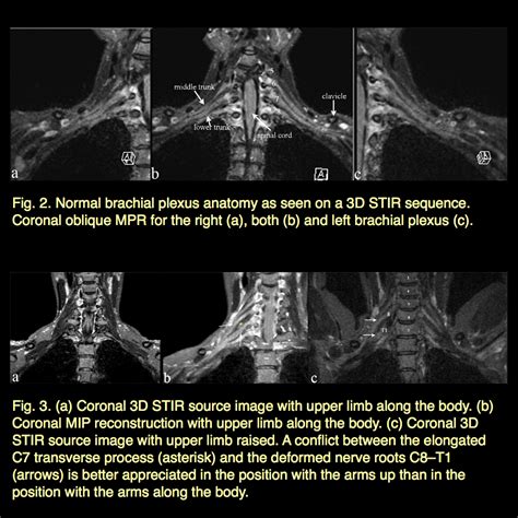 Brachial Plexus Mri Scan