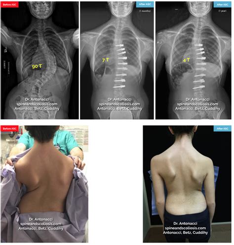 Before and After Scoliosis Surgery with Darryl Antonacci