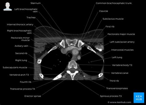 Ct Scan Diagram